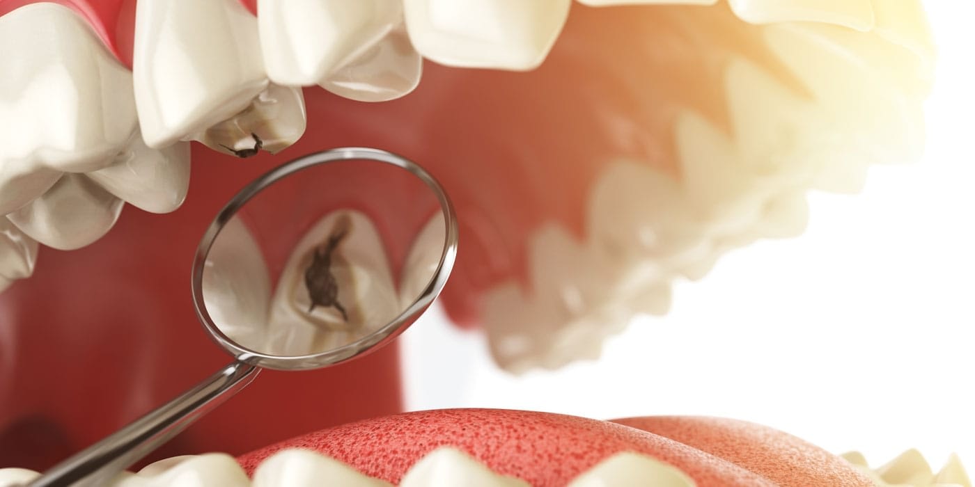 Dental Extractions Dental Extractions