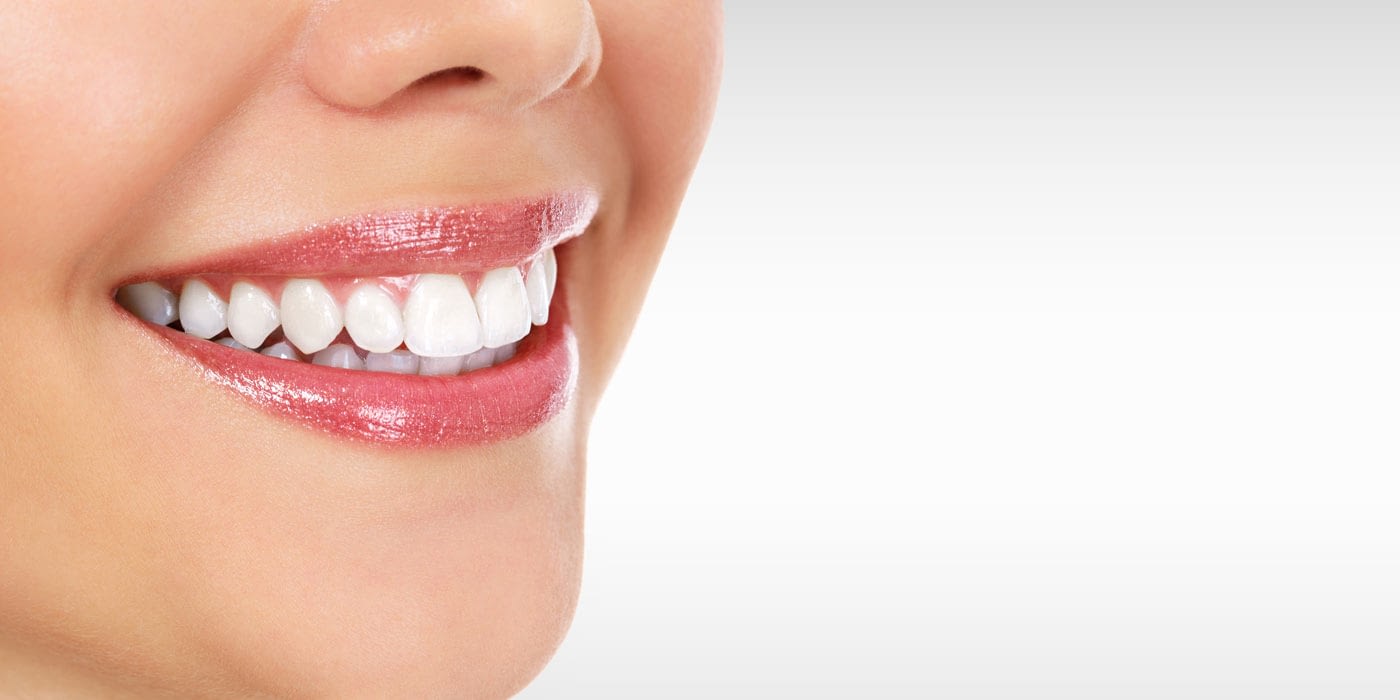 Veneers Veneers